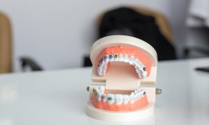 Wisdom Teeth Removal
