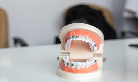 Wisdom Teeth Removal